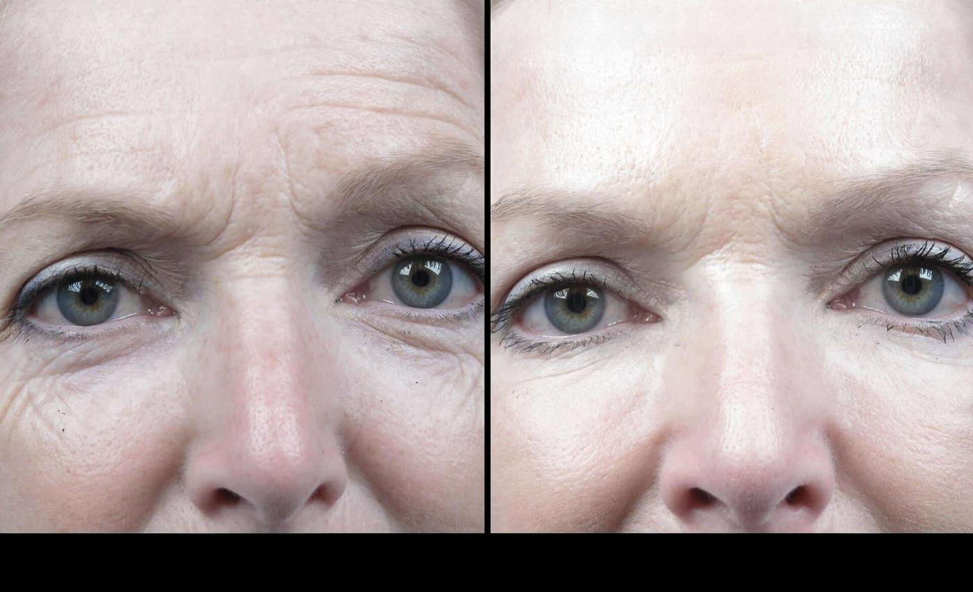 Photo 20 of a Patient Before and After Microdermabrasion in Toronto