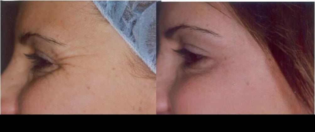 Before and after photo of Botox treatment in Toronto showing significant reduction in crow's feet and smoother skin.