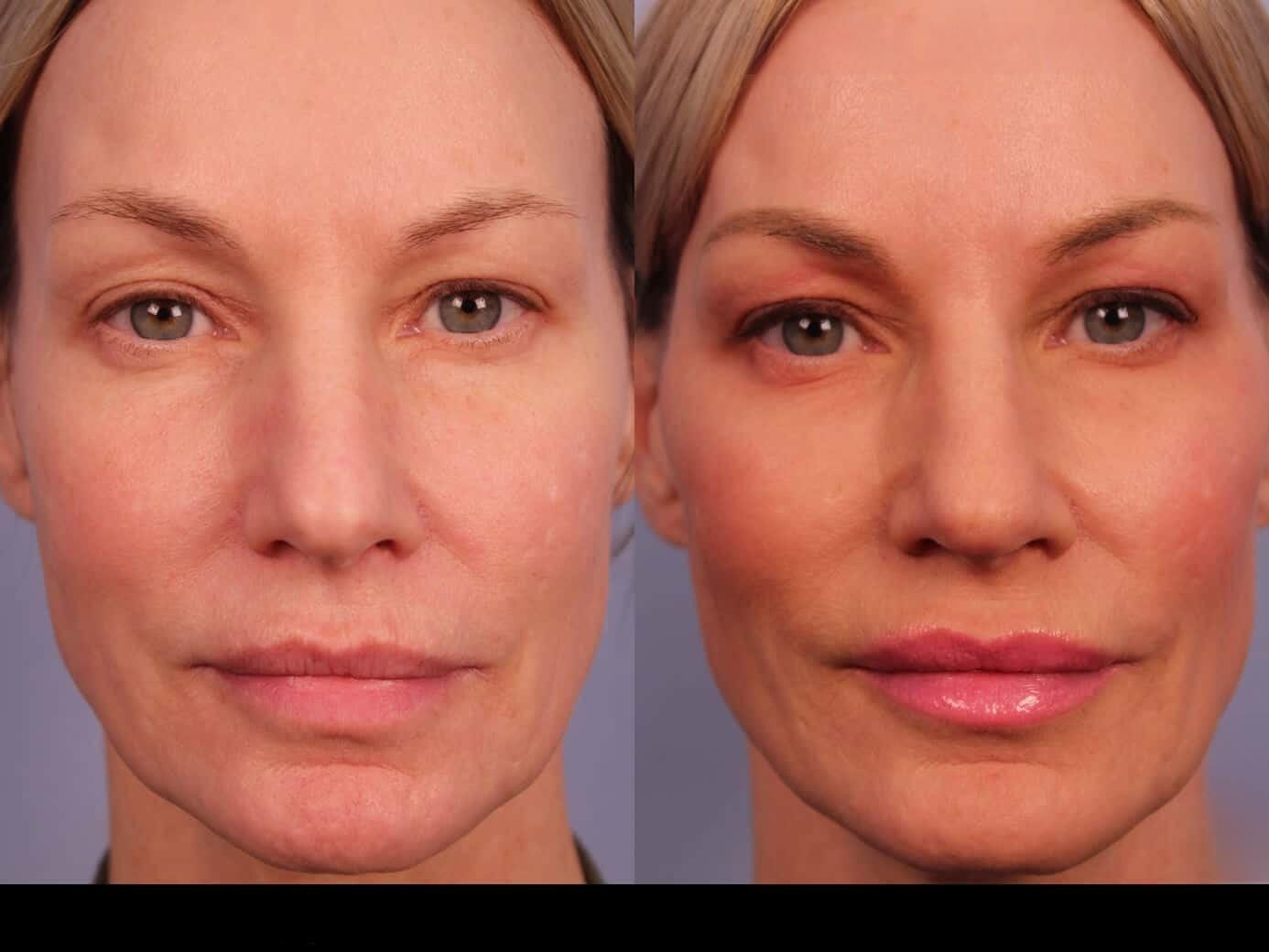 Photo 21 of a Patient Before and After Microdermabrasion in Toronto