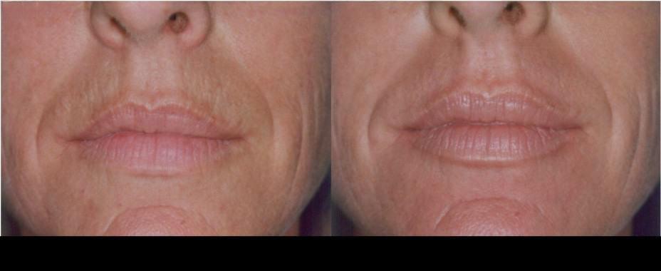 Botox treatment in Toronto before and after results focusing on wrinkle reduction around the mouth and lips.