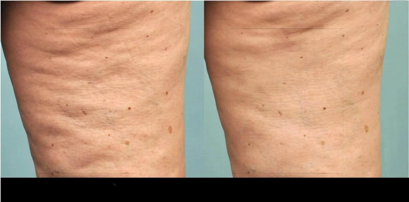 Visible improvement in skin texture after cellulite treatment in Toronto, showing before and after results.