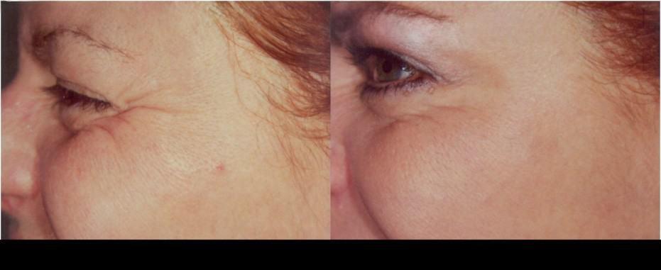 Before and after Botox in Toronto showing smoother skin and reduced wrinkles around the eyes.