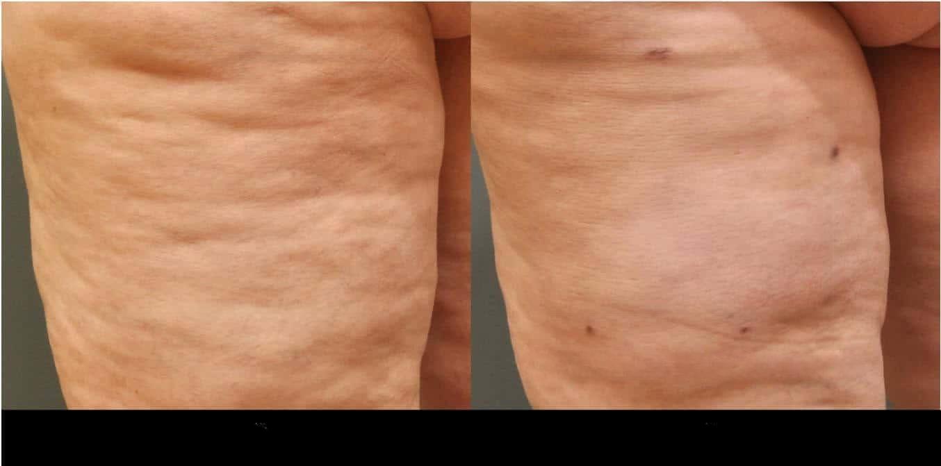Before and after photos of a patient showing effective cellulite reduction treatment in Toronto.