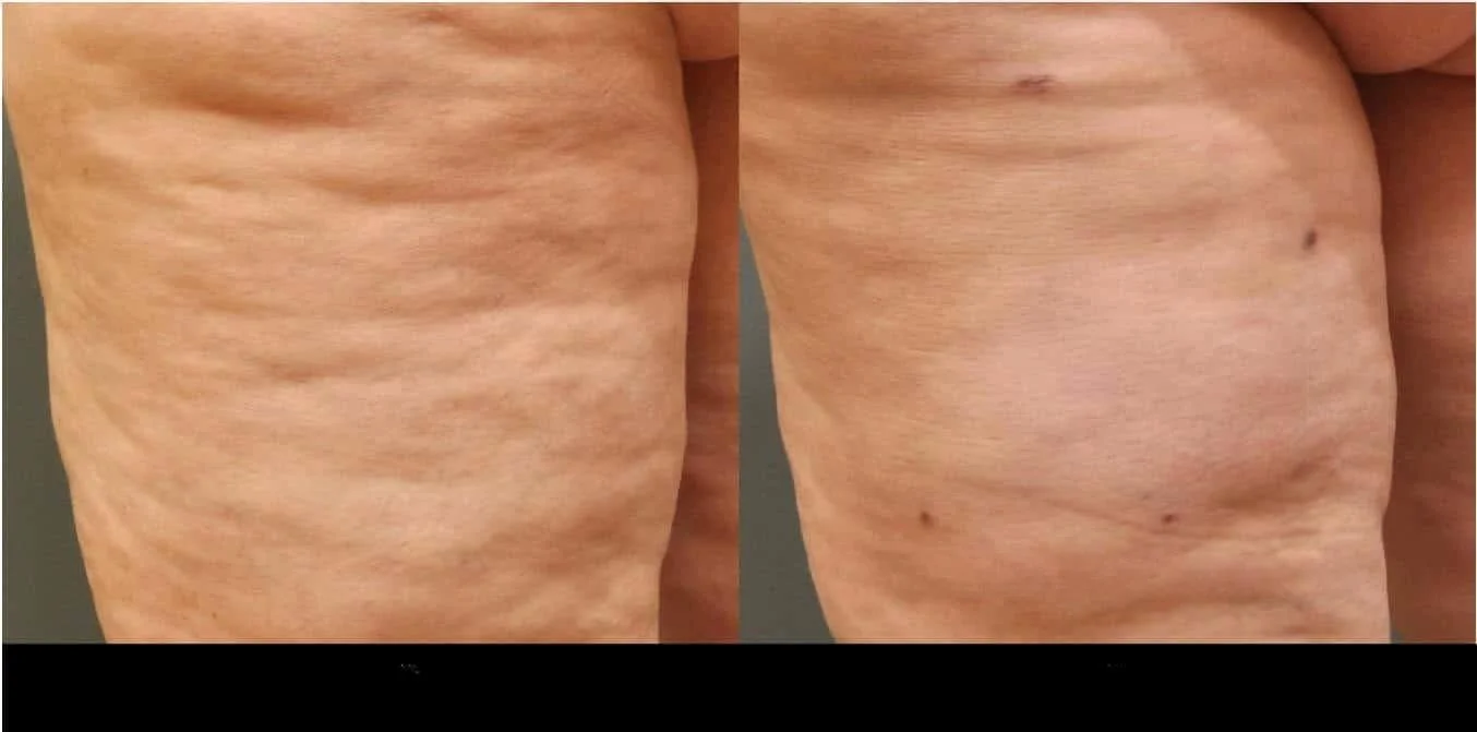 Before and after photos of a patient showing effective cellulite reduction treatment in Toronto.