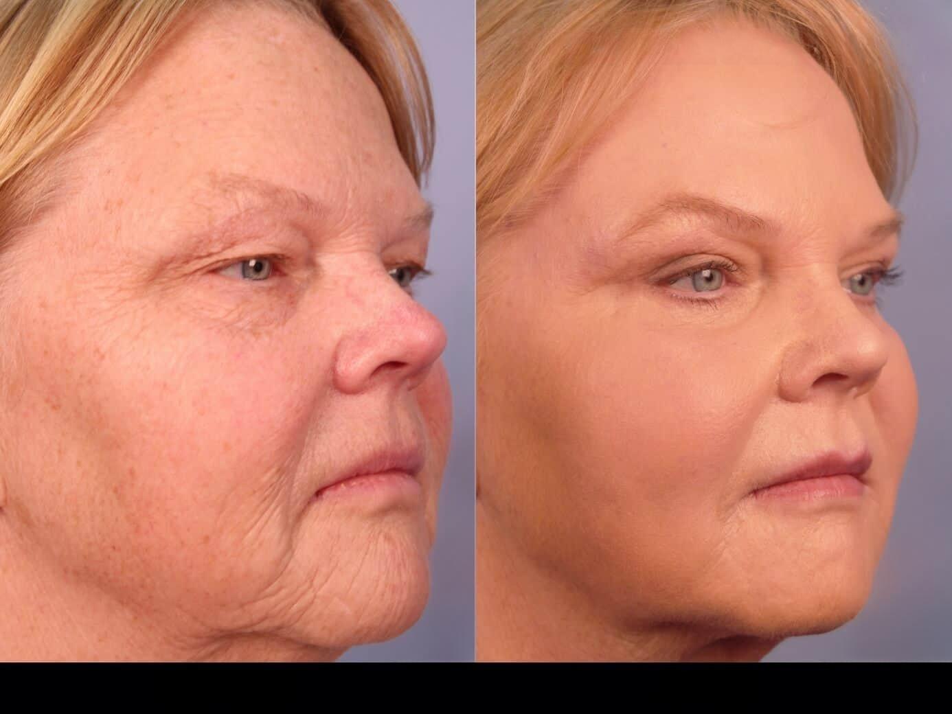 Photo 23 of a Patient Before and After Laser Wrinkle Removal in Toronto.