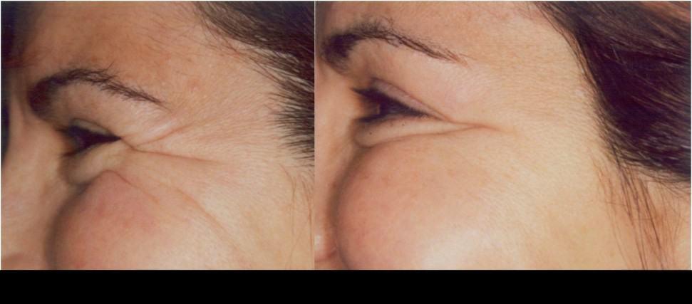 Botox treatment in Toronto showcasing before and after images of reduced crow's feet and smoother skin.