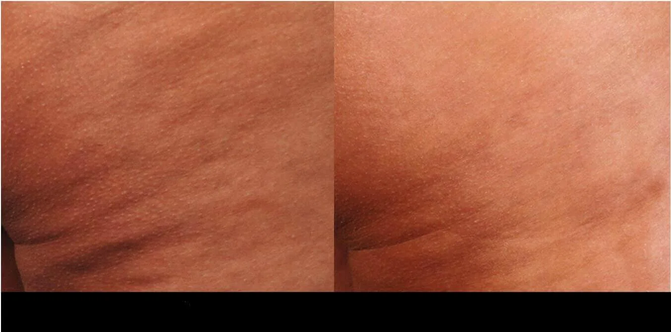 Before and after results of cellulite removal in Toronto, highlighting smoother skin texture.