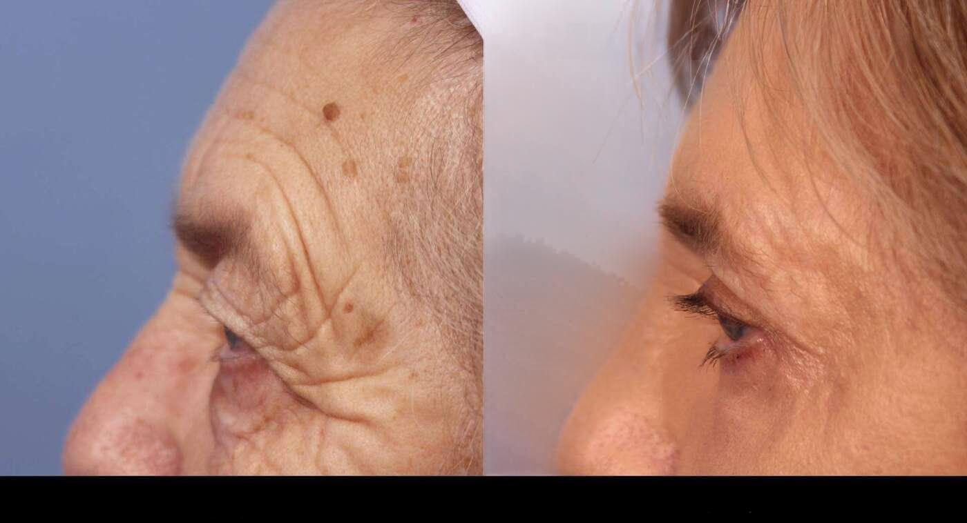 Photo 24 of a Patient Before and After Laser Wrinkle Removal in Toronto.