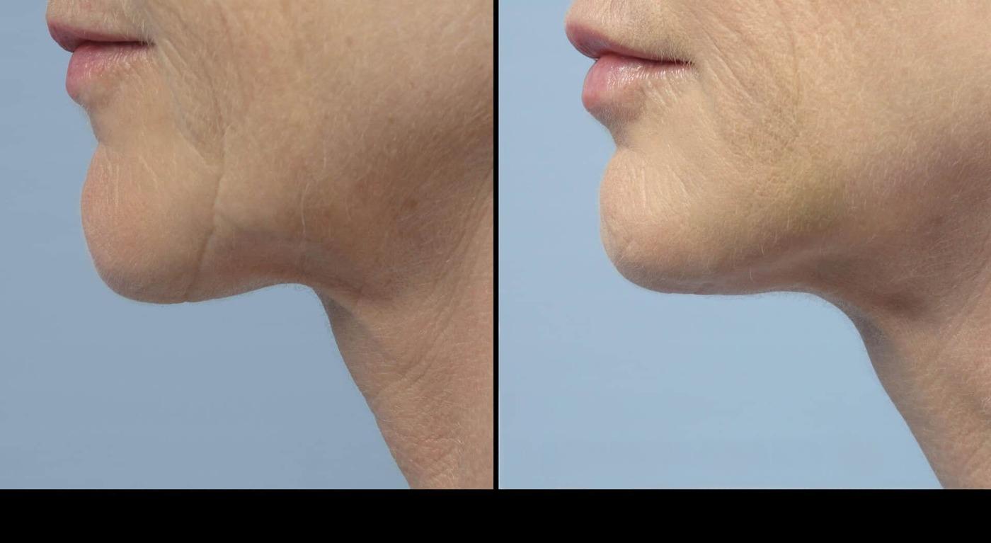 Photo 24 of a Patient Before and After Microdermabrasion in Toronto