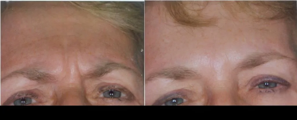 Botox in Toronto before and after image showing reduced frown lines and smoother skin on the forehead.