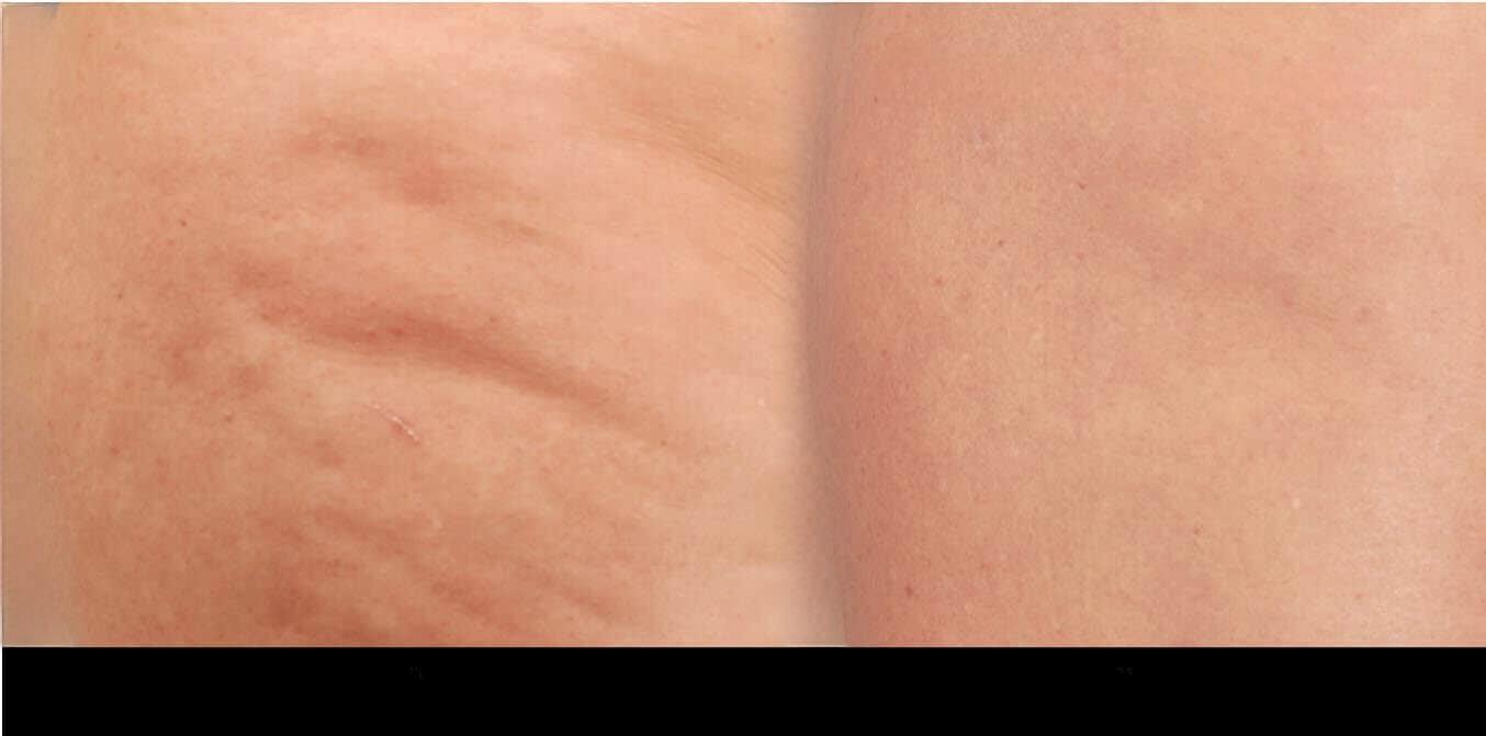 Patient's thigh showing significant improvement after cellulite removal in Toronto, with visible reduction in dimpling.
