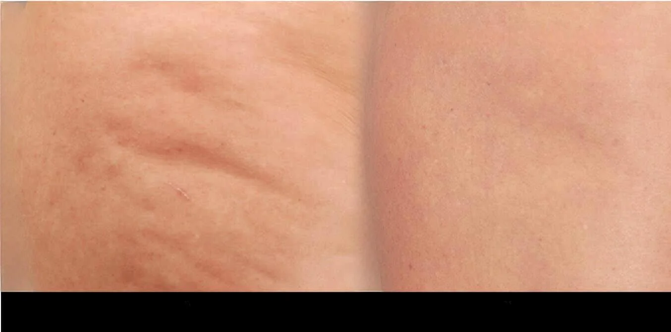 Patient's thigh showing significant improvement after cellulite removal in Toronto, with visible reduction in dimpling.