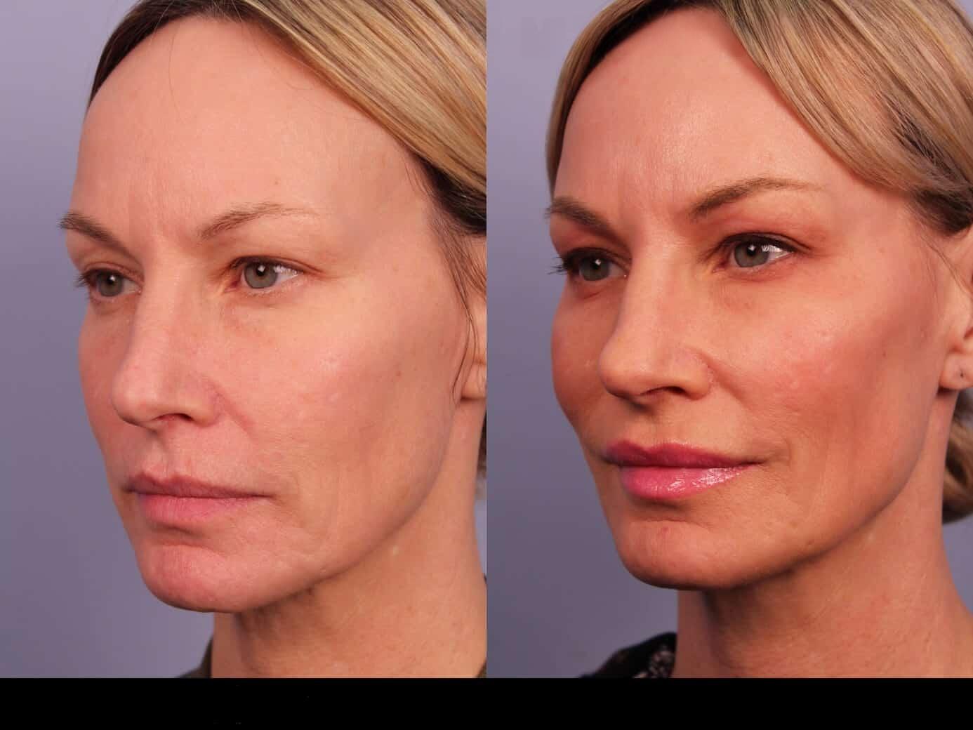 Photo 25 of a Patient Before and After Microdermabrasion in Toronto