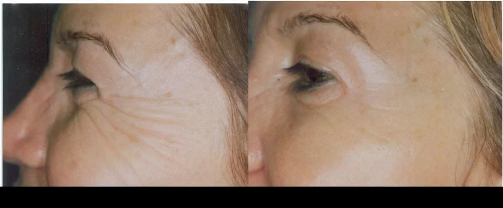 Before and after photo of Botox treatment in Toronto showcasing reduced crow's feet and smoother skin around the eyes.