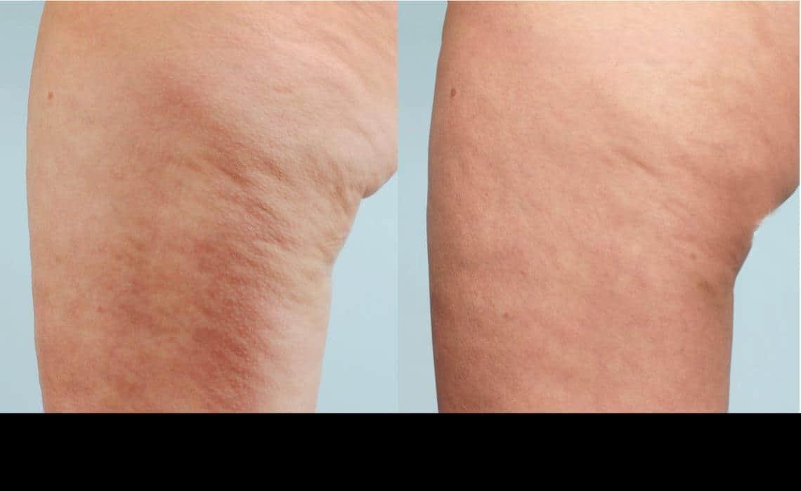 Before and after cellulite reduction treatment in Toronto, showcasing smoother and firmer skin.