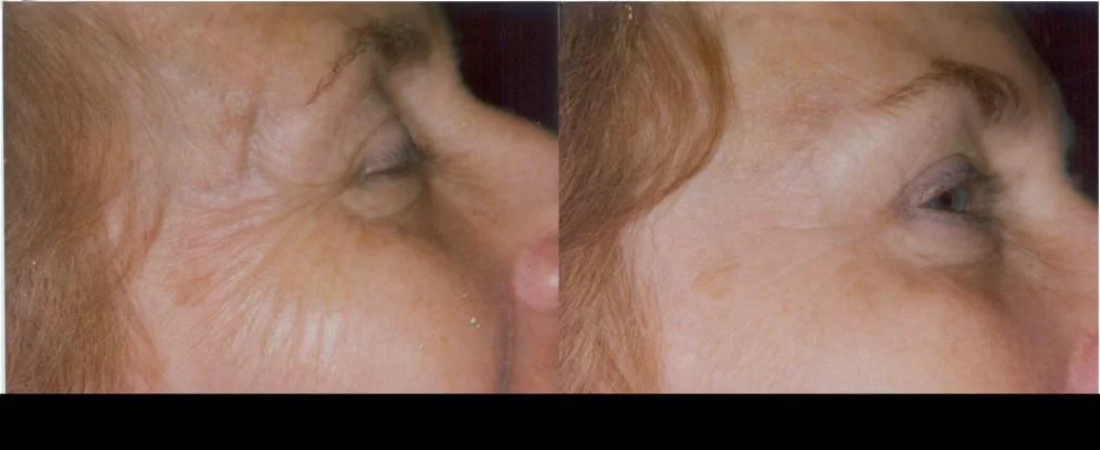 Botox treatment in Toronto highlighting before and after results with smoother skin and reduced wrinkles around the eyes.