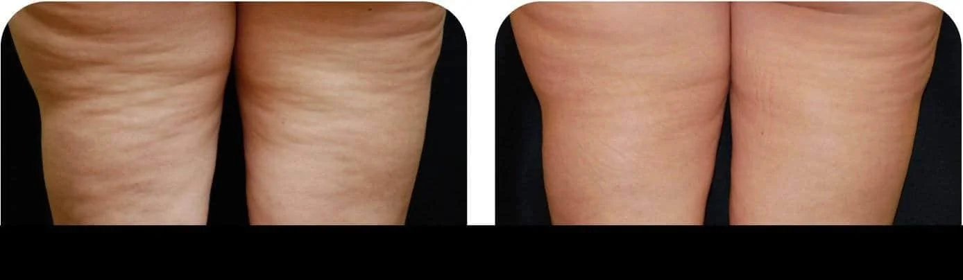 Comparison of cellulite removal results in Toronto, with a clear improvement in skin smoothness and texture.