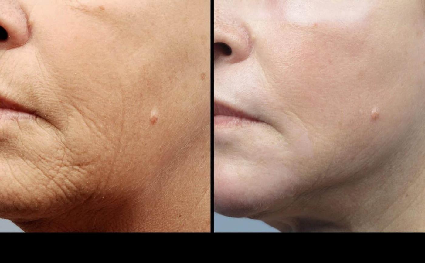 Photo 27 of a Patient Before and After Microdermabrasion in Toronto