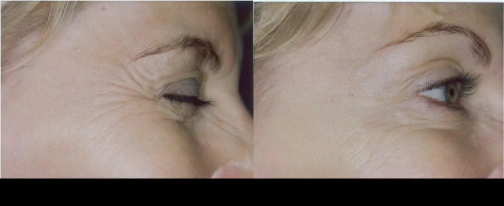 Before and after Botox in Toronto showing a significant reduction in crow's feet and smoother skin near the eyes.