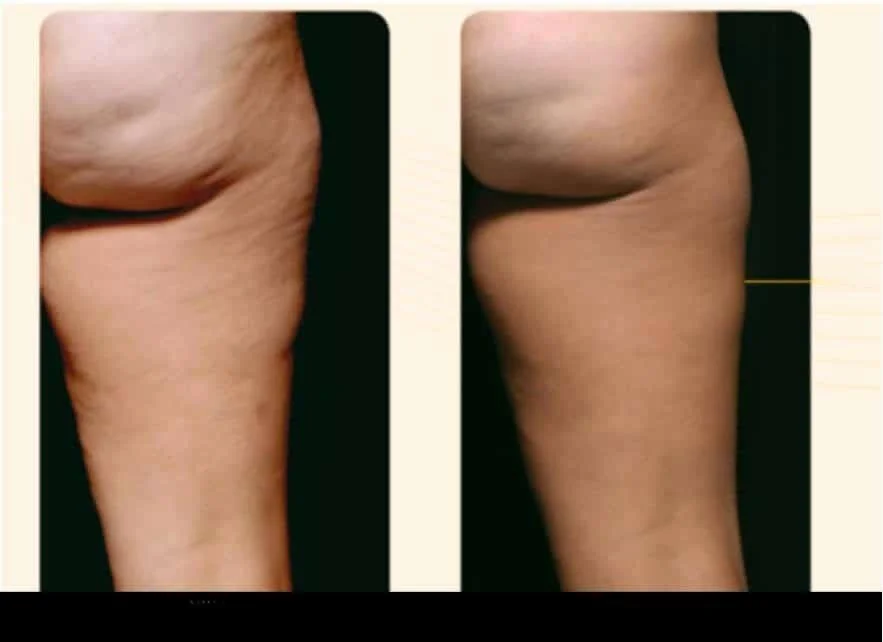 Before and after photos of a patient showing cellulite removal in Toronto, highlighting smoother thighs.