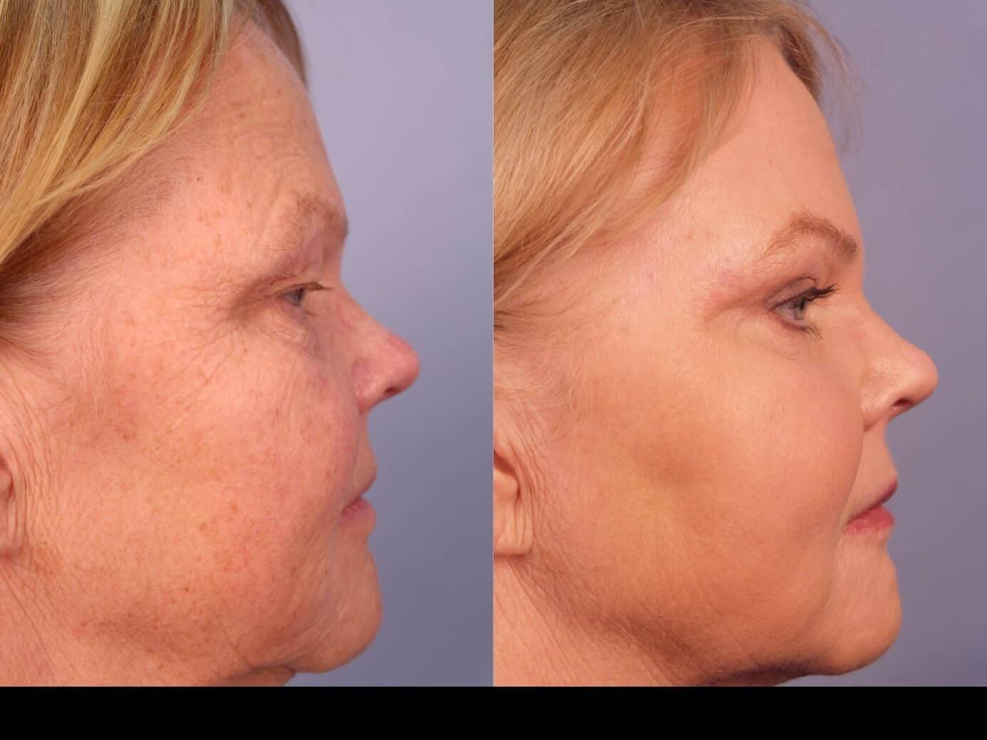 Photo 28 of a Patient Before and After Laser Wrinkle Removal in Toronto.