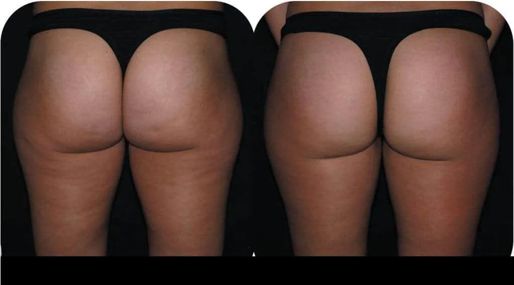 Before and after cellulite reduction results in Toronto, showing a noticeable improvement in skin texture on the buttocks.