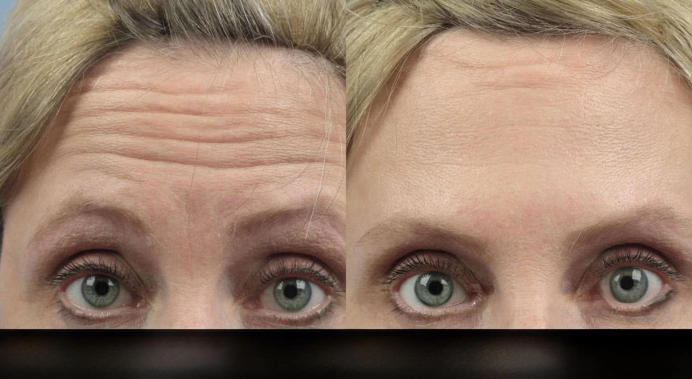 Botox in Toronto before and after image focusing on wrinkle reduction in the forehead area.