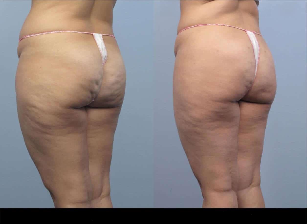 Before and after cellulite treatment in Toronto showing a reduction in cellulite and smoother skin on the patient's thighs and buttocks.