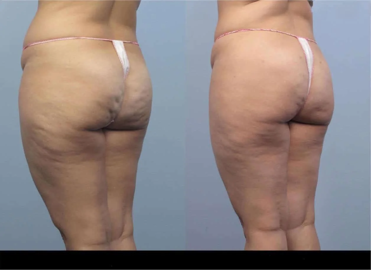 Before and after cellulite treatment in Toronto showing a reduction in cellulite and smoother skin on the patient's thighs and buttocks.