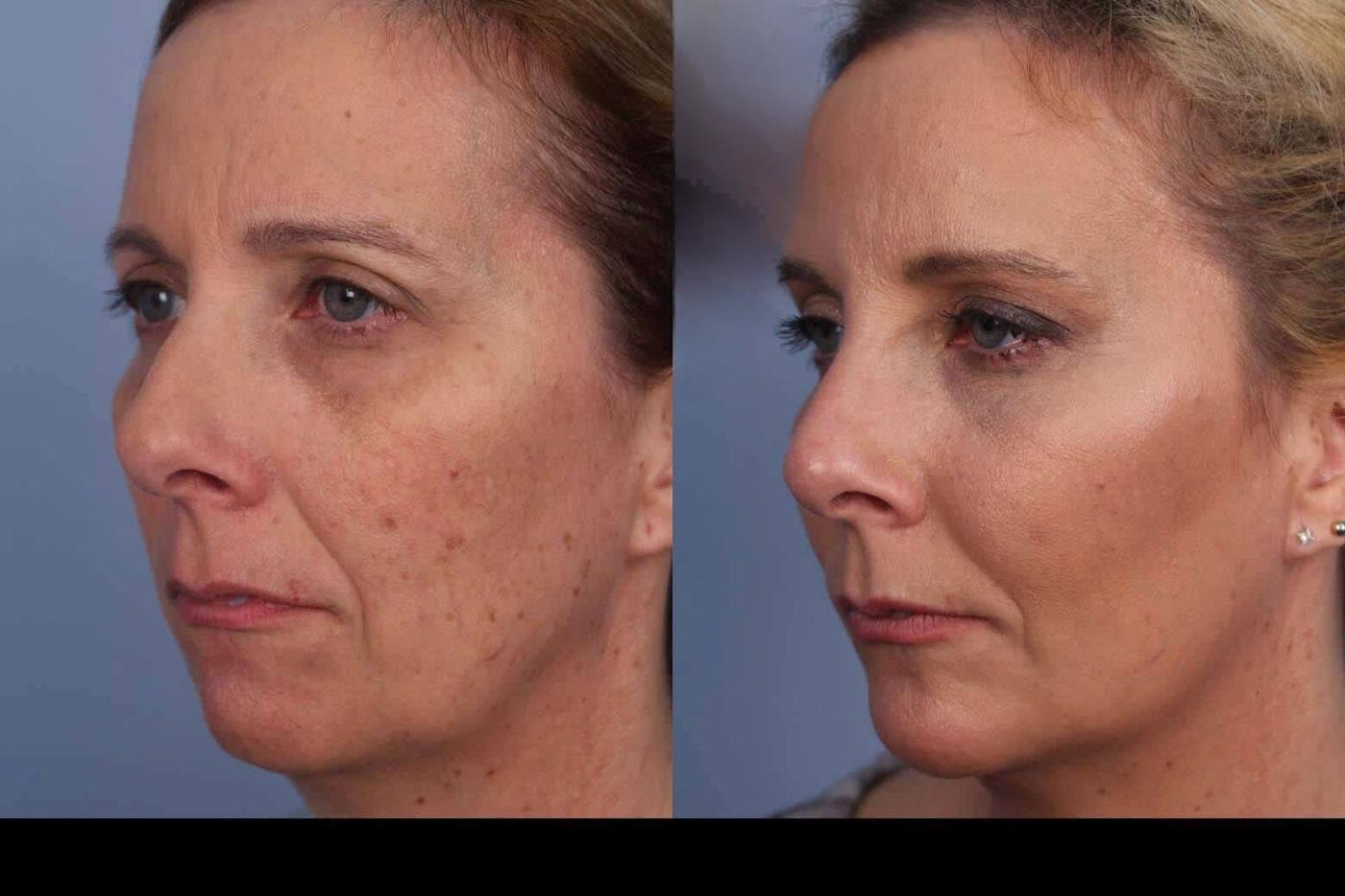 Photo 3 of a Patient Before and After IPL Photofacial Treatment in Toronto.