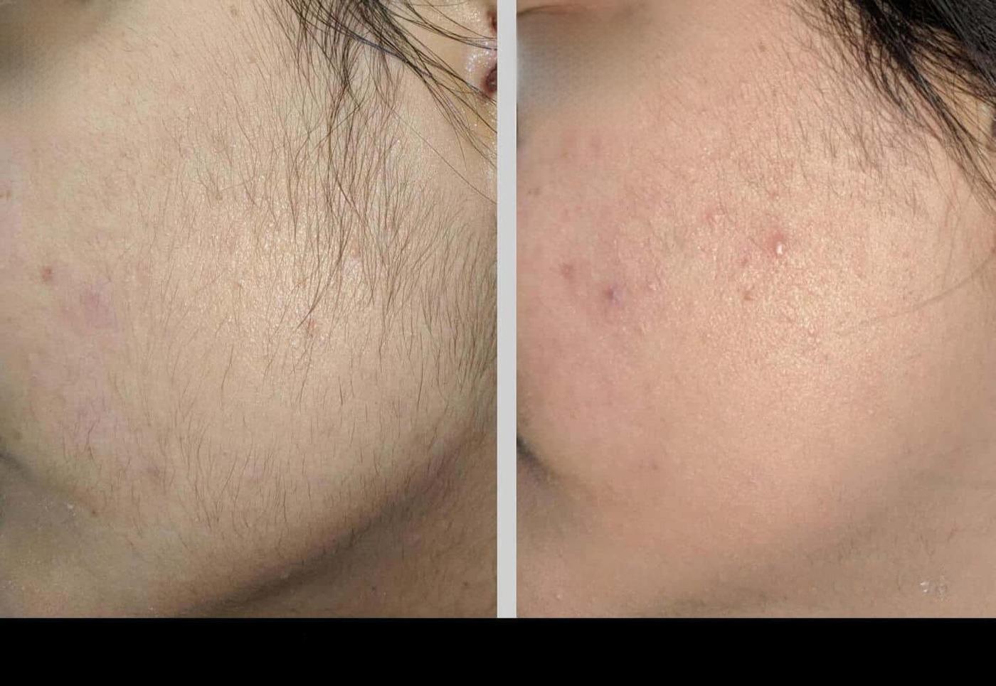 Photo 3 of a Patient Before and After Laser Hair Removal in Toronto.