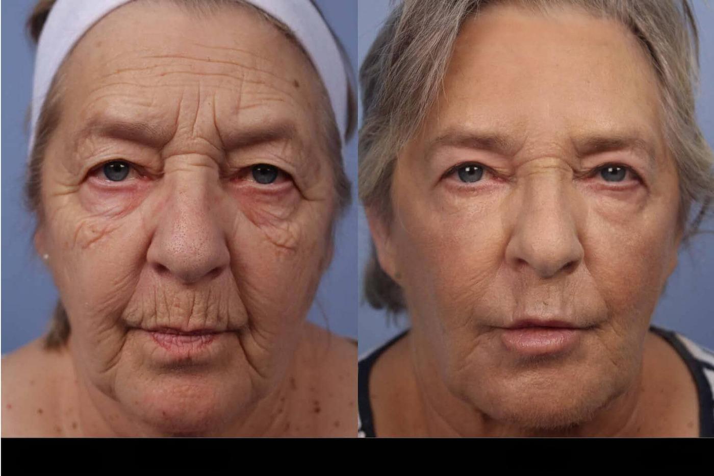 Photo 3 of a Patient Before and After Laser Wrinkle Removal in Toronto.
