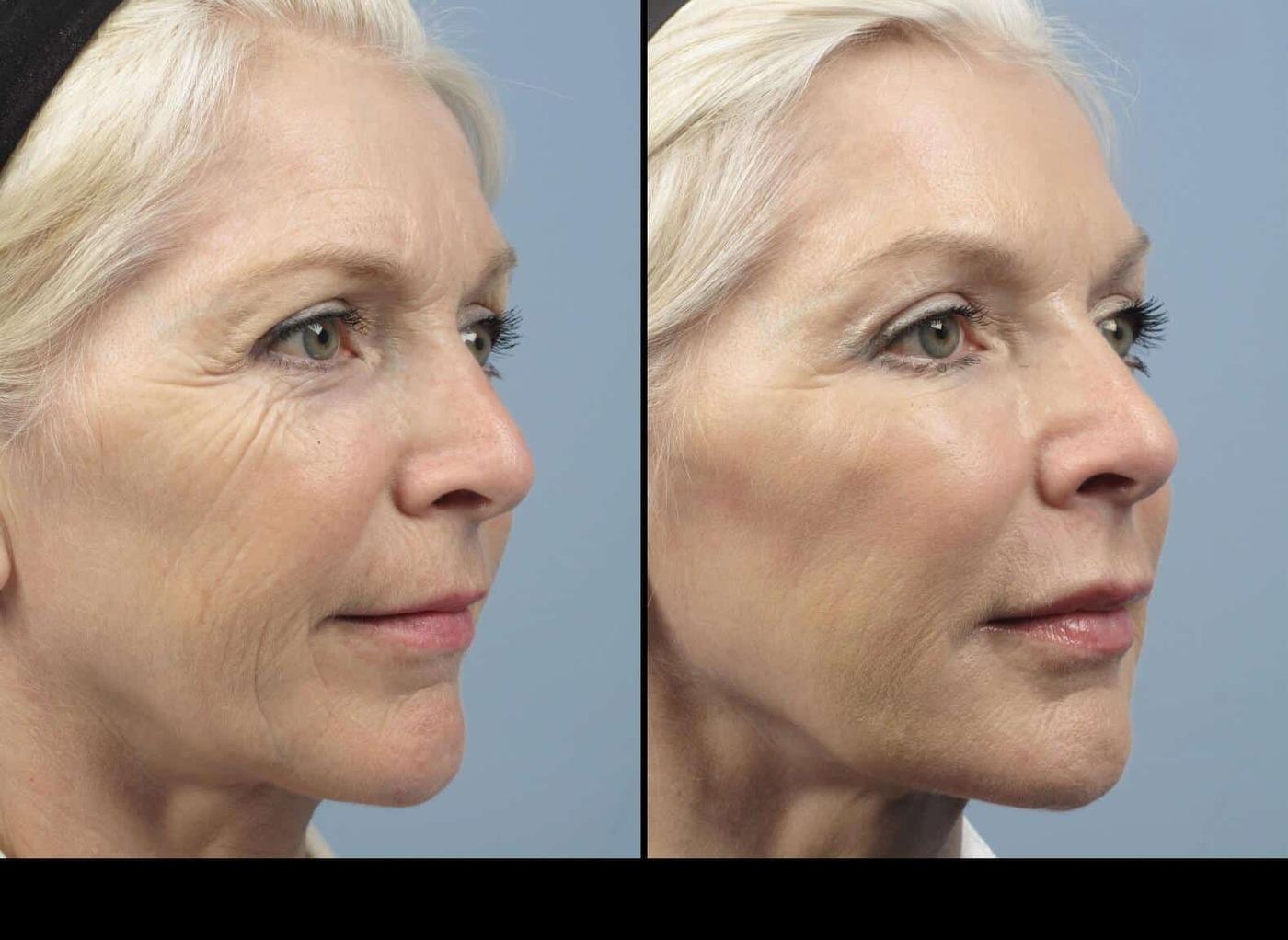 Photo 3 of a Patient Before and After Microdermabrasion in Toronto
