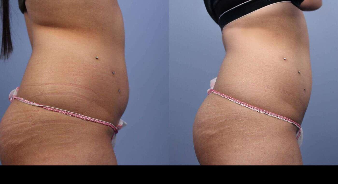 Photo 3 of a Patient Before and After Non-Surgical Body Contouring in Toronto.