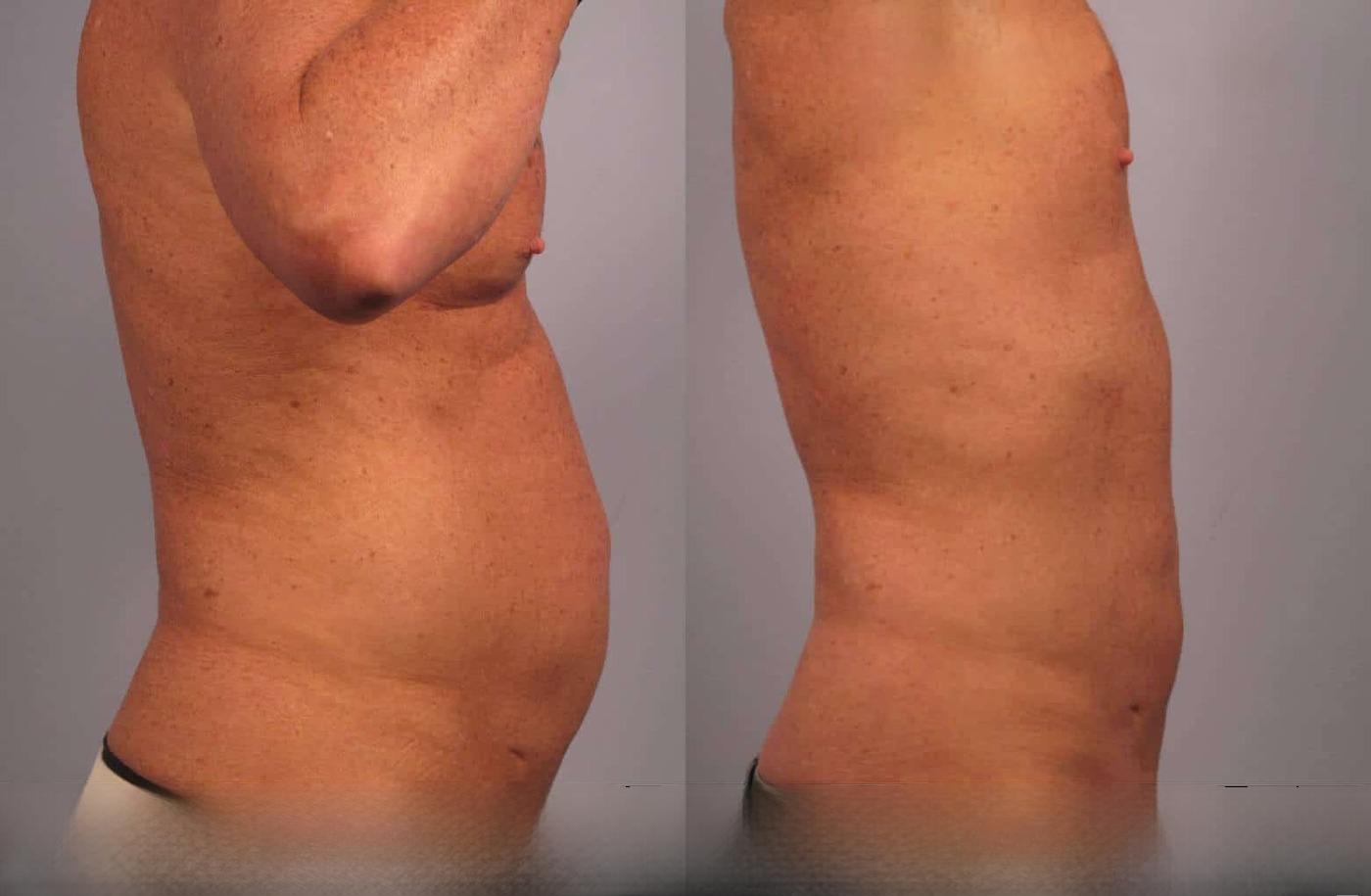 Photo 3 of a Patient Before and After Non-Surgical Liposuction in Toronto.