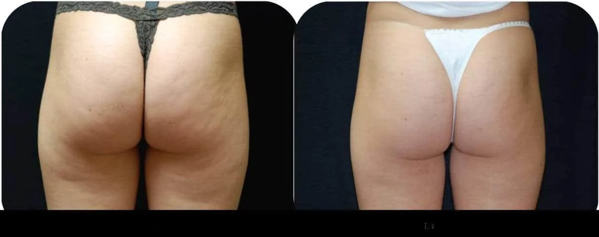 Successful cellulite reduction treatment in Toronto, shown in before and after images of the buttocks.