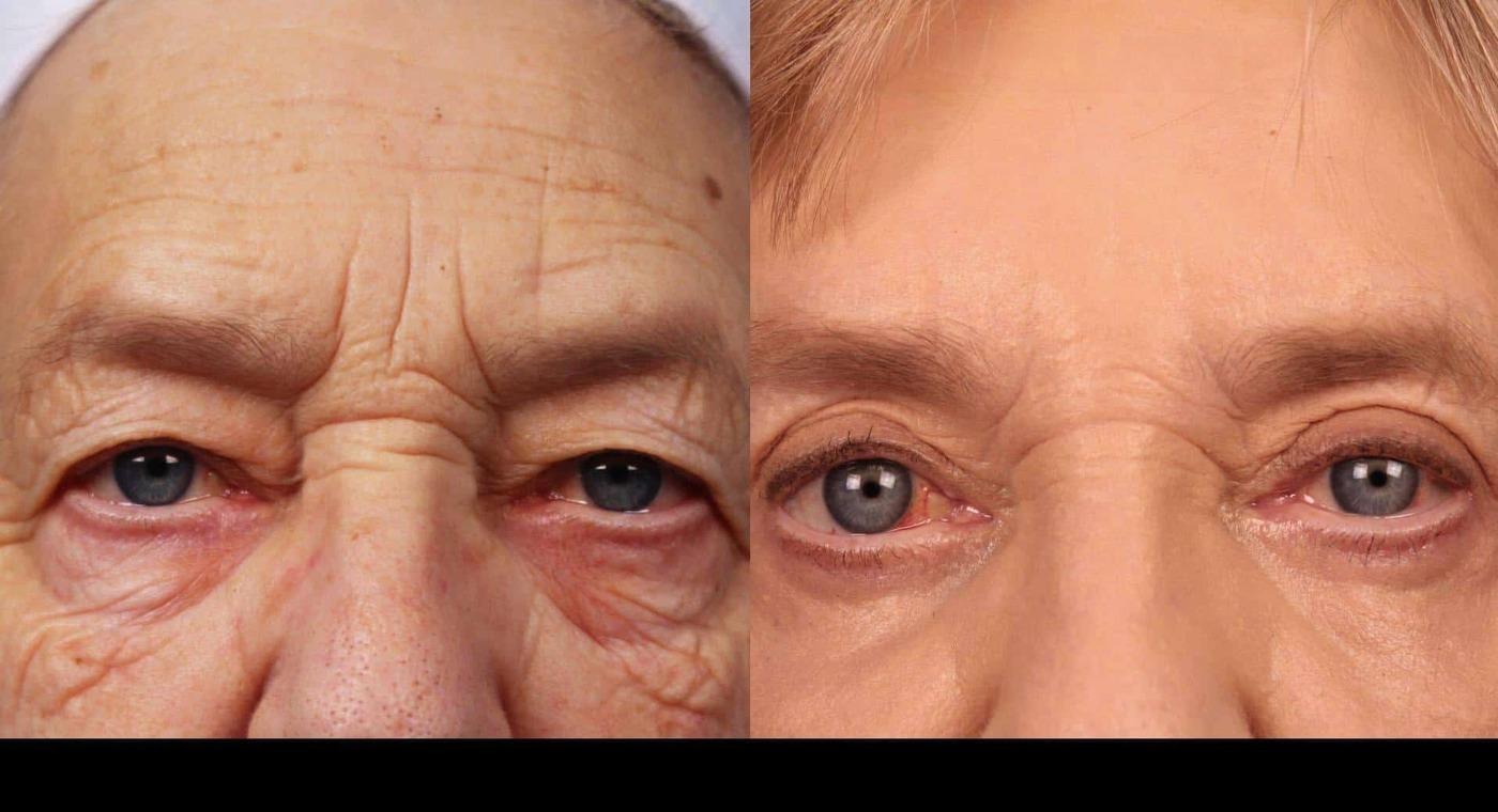 Photo 30 of a Patient Before and After Laser Wrinkle Removal in Toronto.