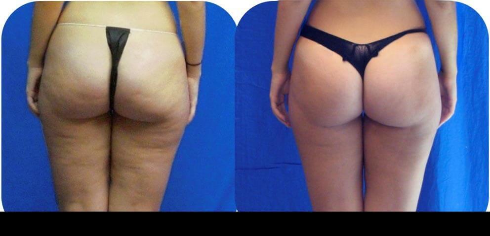 Cellulite removal in Toronto with before and after comparison highlighting smoother skin on the lower body.