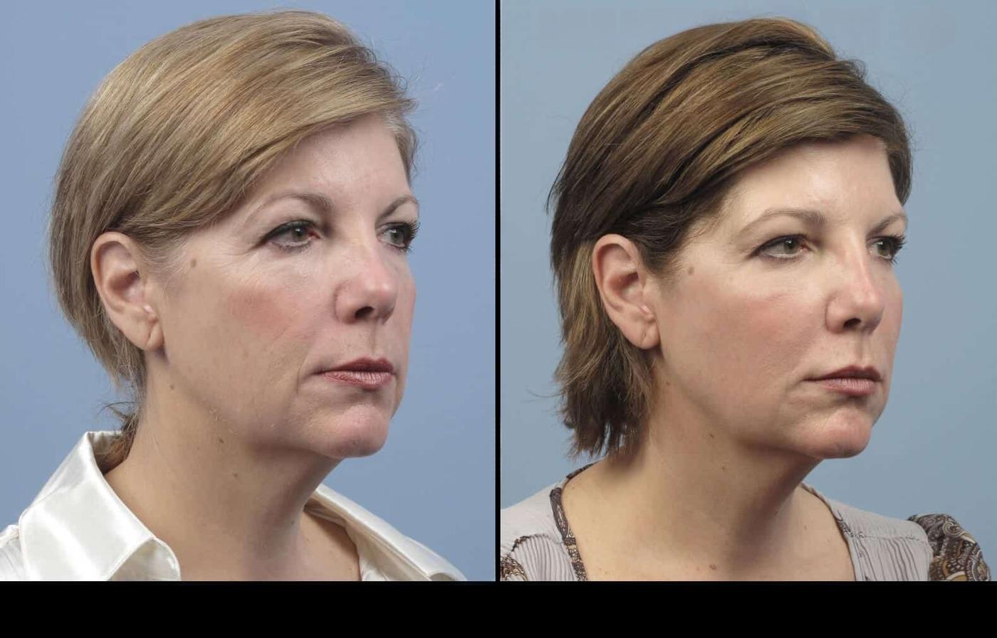 Photo 31 of a Patient Before and After Laser Wrinkle Removal in Toronto.