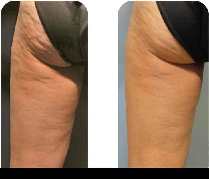 Before and after photos of a patient's thigh showing effective cellulite reduction treatment in Toronto.