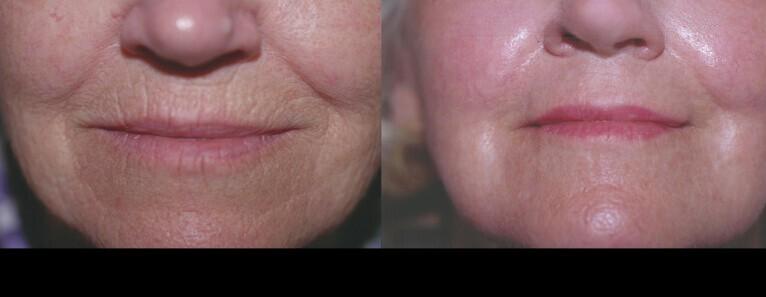 Photo 32 of a Patient Before and After Laser Wrinkle Removal in Toronto.