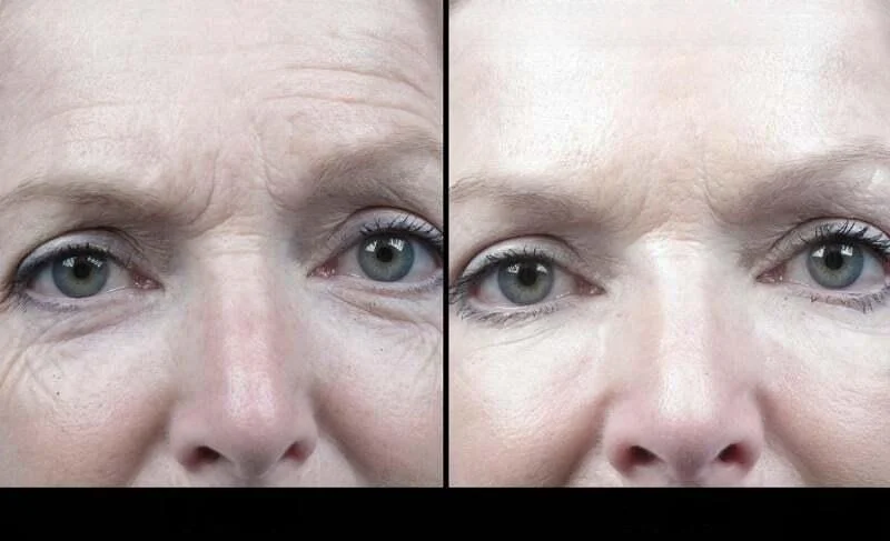 Results of Botox treatment in Toronto before and after photos showing diminished facial lines.