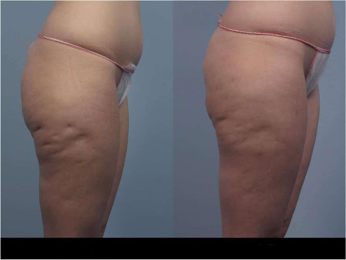 Cellulite removal in Toronto before and after image showcasing smoother skin and reduced cellulite on the side of the thighs.