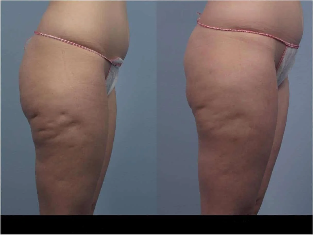 Cellulite removal in Toronto before and after image showcasing smoother skin and reduced cellulite on the side of the thighs.
