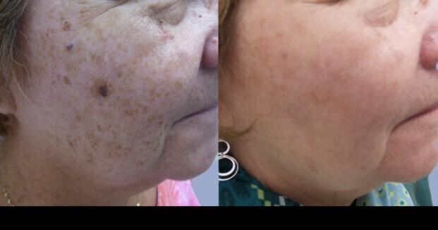 Photo 4 of a Patient Before and After IPL Photofacial Treatment in Toronto.