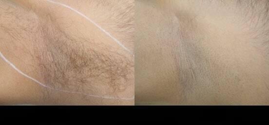 Photo 4 of a Patient Before and After Laser Hair Removal in Toronto.