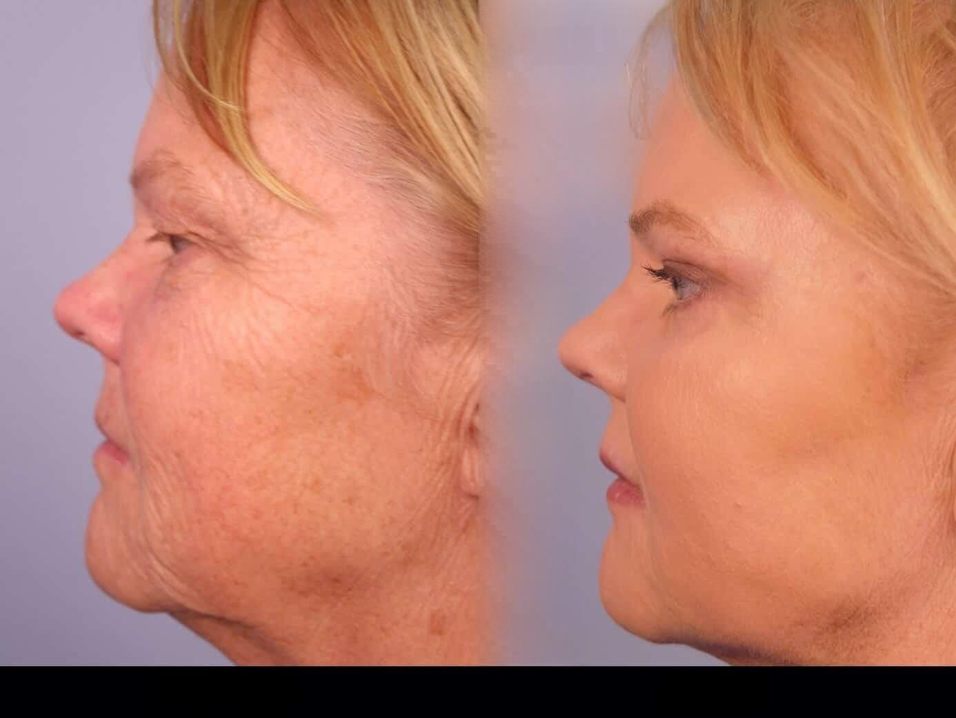 Photo 4 of a Patient Before and After Laser Wrinkle Removal in Toronto.