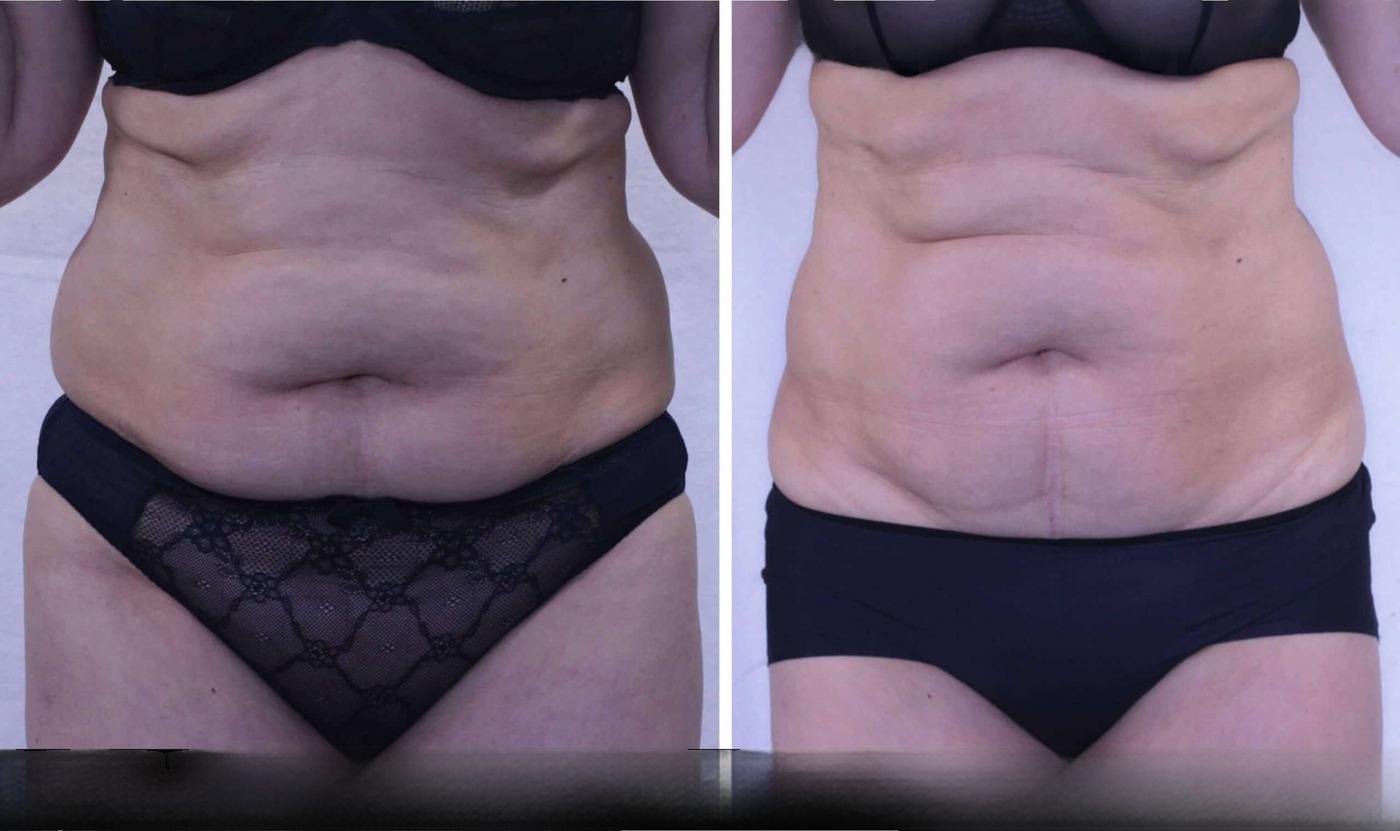 Photo 4 of a Patient Before and After Non-Surgical Body Contouring in Toronto.