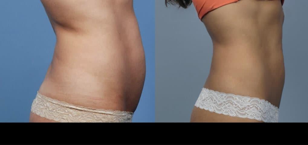 Photo 4 of a Patient Before and After Non-Surgical Liposuction in Toronto.