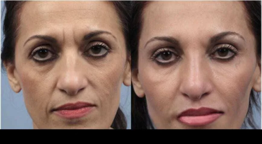 Botox in Toronto before and after results featuring a patient with smoother skin and reduced wrinkles.